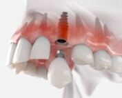 cuantos implantes dentales se pueden poner en un día