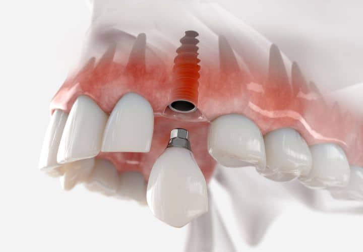 cuantos implantes dentales se pueden poner en un día