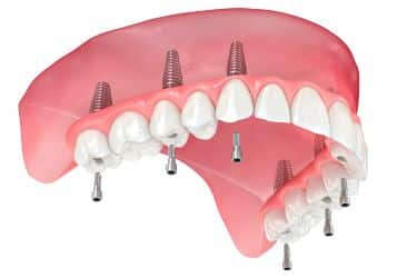 microtornillos invisalign