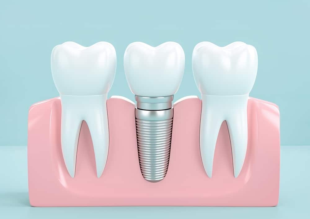 ¿Cuánto se tarda en poner un implante dental?