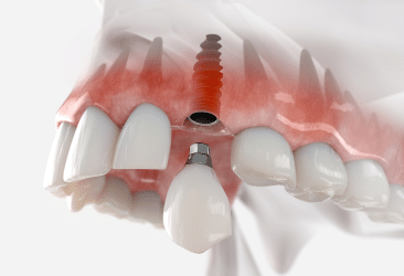 poner implantes dentales duele