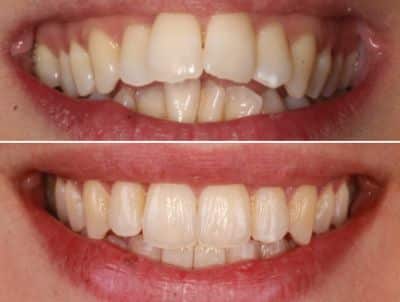 ortodoncia adolescentes (1)