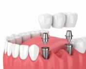 puente sobre implantes