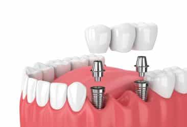 puente sobre implantes