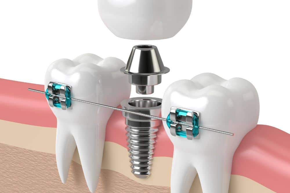 ¿Se puede poner ortodoncia con implantes?