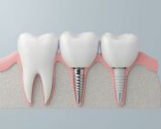 mejores marcas implantes dentales