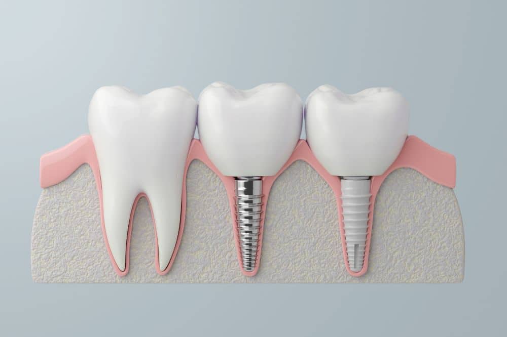 mejores marcas implantes dentales