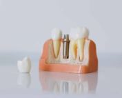 implantes dentales sin hueso