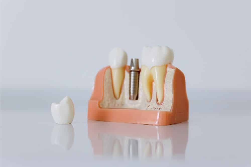 implantes dentales sin hueso